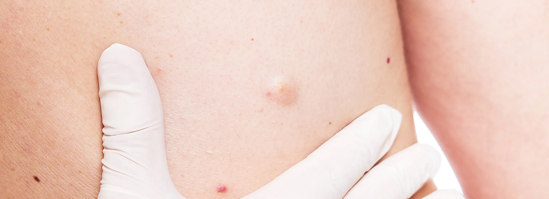 Poliklinika Beograd |Uklanjanje ateroma